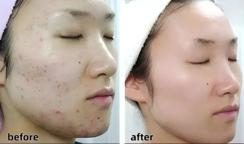 Acne-Reducing Liquid Dressing